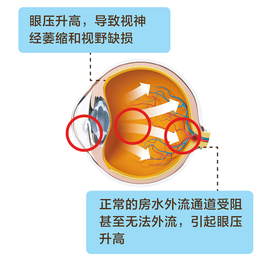 案例故事 | 1岁半男童眼睛太好看查出致盲眼病？听听专家怎么说？